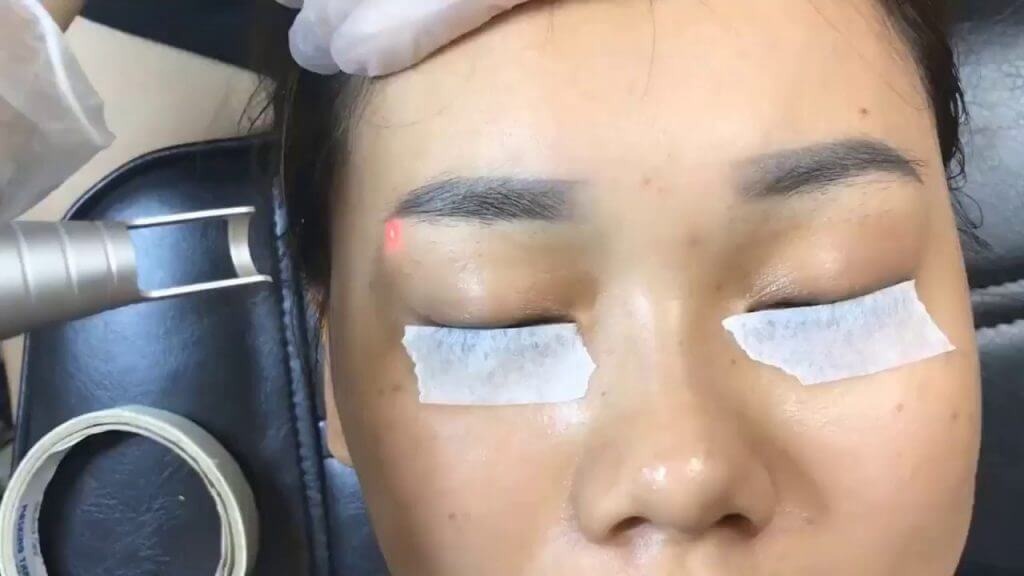Hút mực phun lông mày bằng Laser thường mang lại kết quả tốt nhất