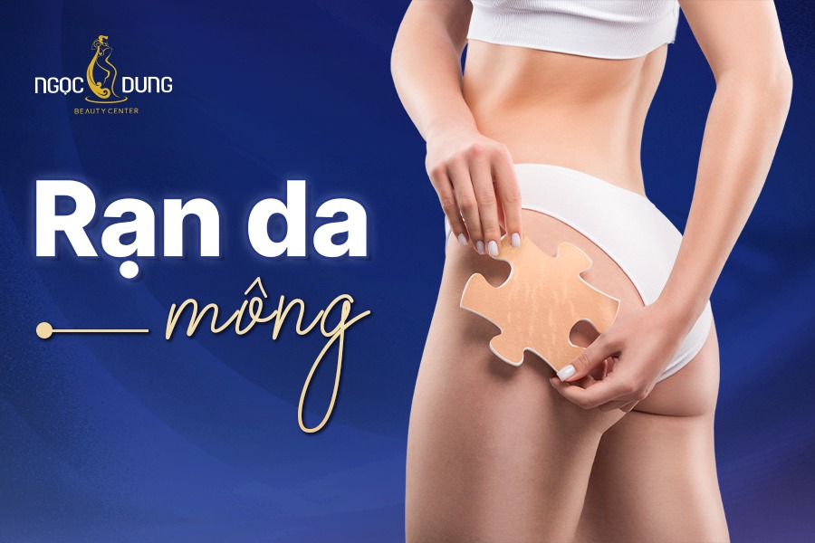 Rạn da mông