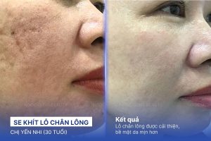 Chị Yến Nhi (30 tuổi) - Se Khít Lỗ Chân Lông