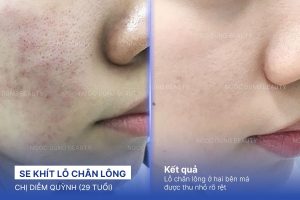 Chị Diễm Quỳnh (29 tuổi) - Se Khít Lỗ Chân Lông