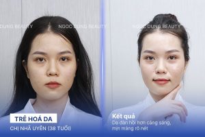 Chị Nhã Uyên (38 tuổi) - Trẻ Hoá Da
