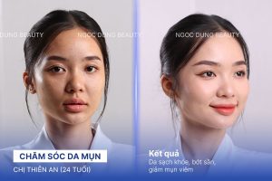Chị Thiên An (24 tuổi) - Chăm Sóc Da Mụn