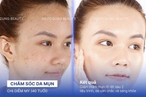 Chị Diễm My (40 tuổi) - Chăm Sóc Da Mụn