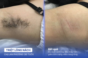 Triệt lông nách – 7 buổi – Nách thông thoáng và khô ráo cả ngày
