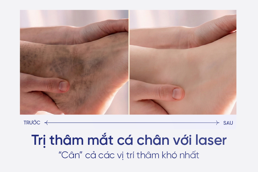 Trị thâm mắt cá chân hiệu quả giúp bạn tự tin diện sandal mỗi ngày