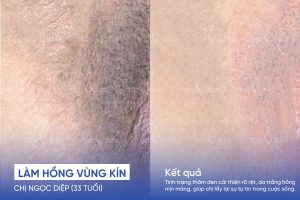 Chị Ngọc Diệp (33 tuổi) - Trị thâm vùng kín