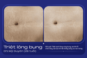 anh truoc sau triet long bung 2