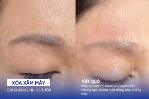 ảnh trước sau xóa xăm mày 3