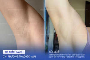 Chị Phương Thảo (30 tuổi) - Trị thâm nách