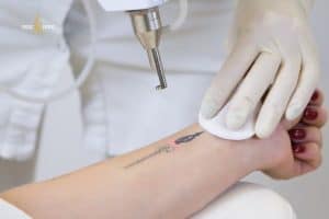 Hình xăm càng đậm và càng lớn thì giá xóa hình xăm​ càng cao