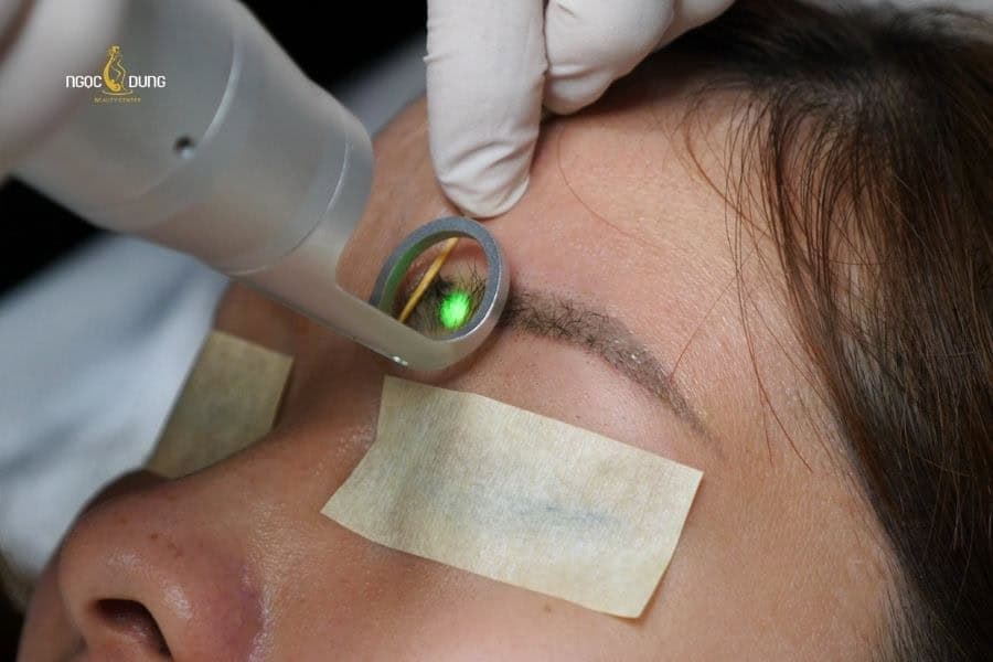 Laser là công nghệ xóa xăm hiện đại nhất ngày nay
