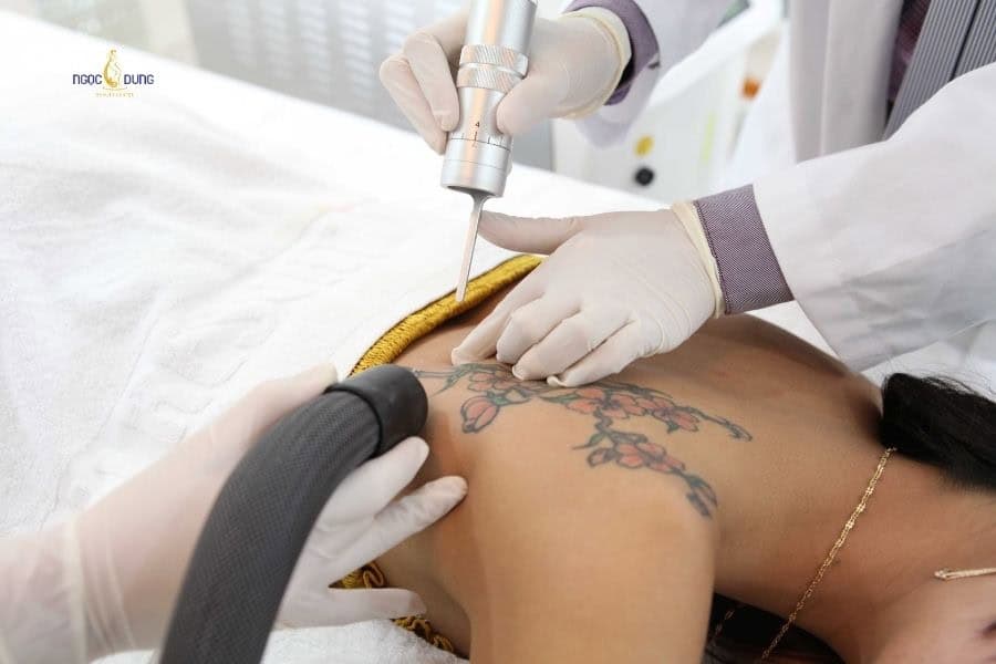Laser là giải pháp xóa xăm phổ biến